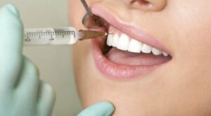 Gummy Smile Correction